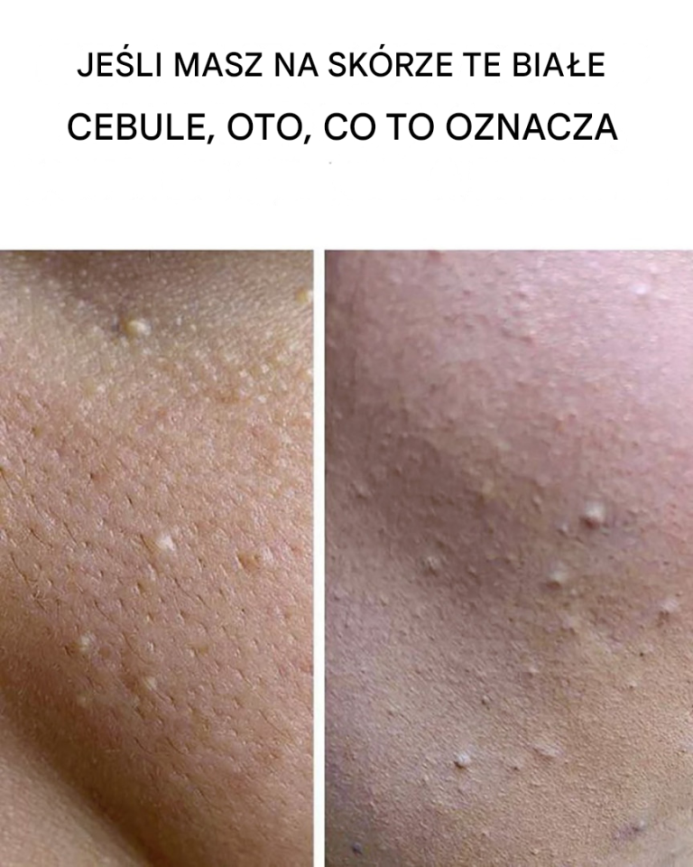 Białe kulki na skórze: co oznaczają?