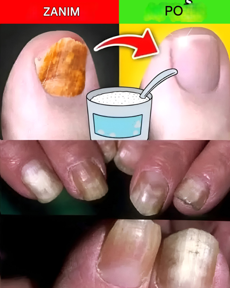 Jak naturalnie pozbyć się grzybicy paznokci?