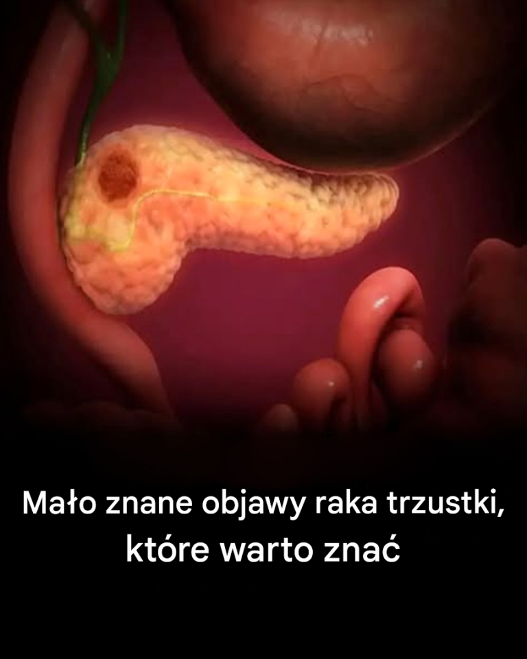 Objawy raka trzustki