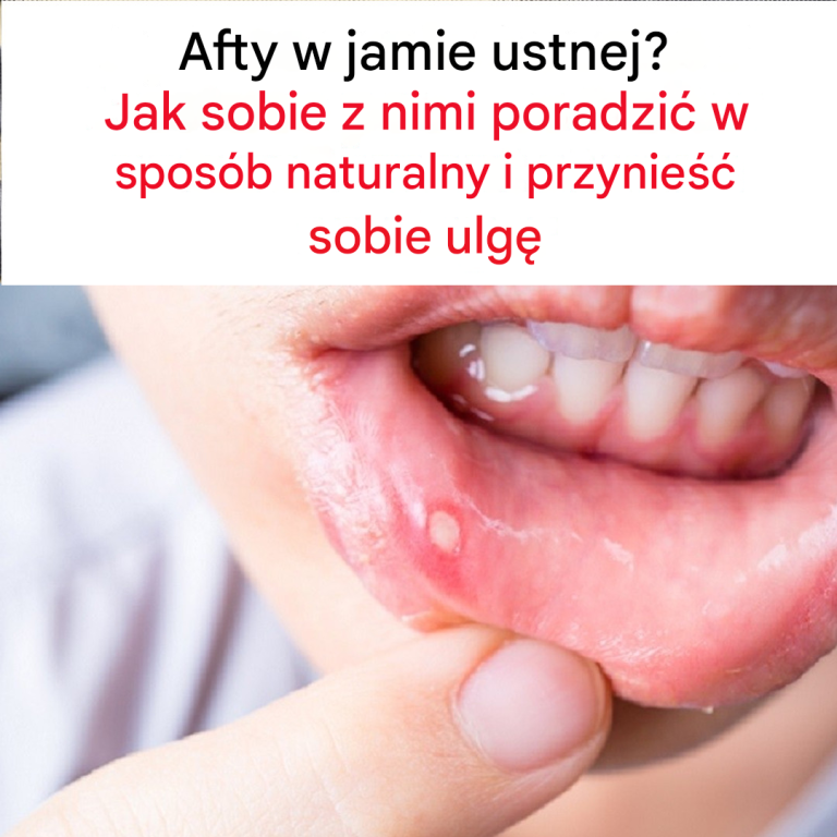 Afty: najlepsze naturalne sposoby ich łagodzenia