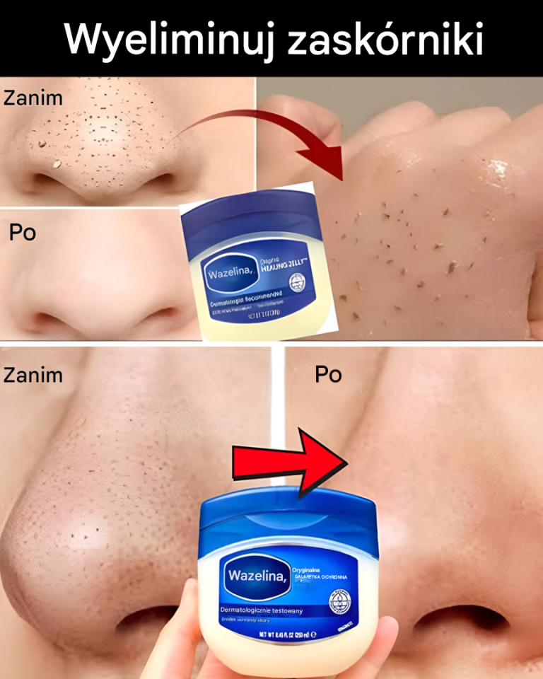 Jak naturalnie usunąć zaskórniki i wągry z nosa i twarzy za pomocą wazeliny