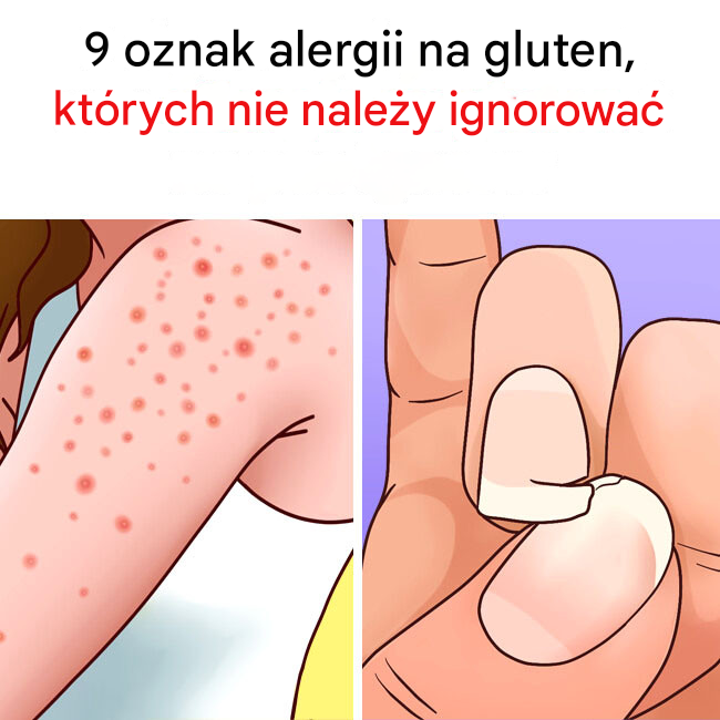 9 oznak alergii na gluten