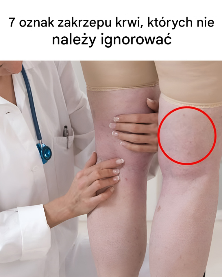 Jak wygląda skrzep krwi? Eksperci wymieniają typowe oznaki i objawy