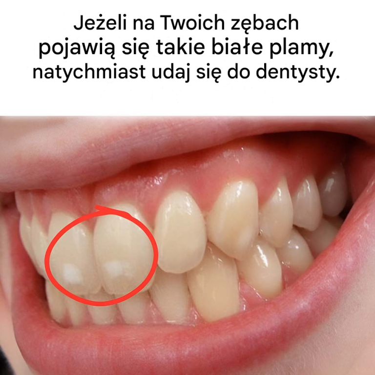 Jak wykryć pierwsze oznaki próchnicy zębów
