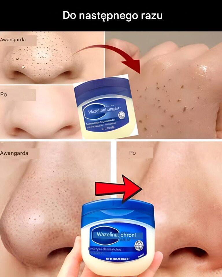 Jak naturalnie usunąć zaskórniki i pryszcze z nosa i twarzy za pomocą wazeliny
