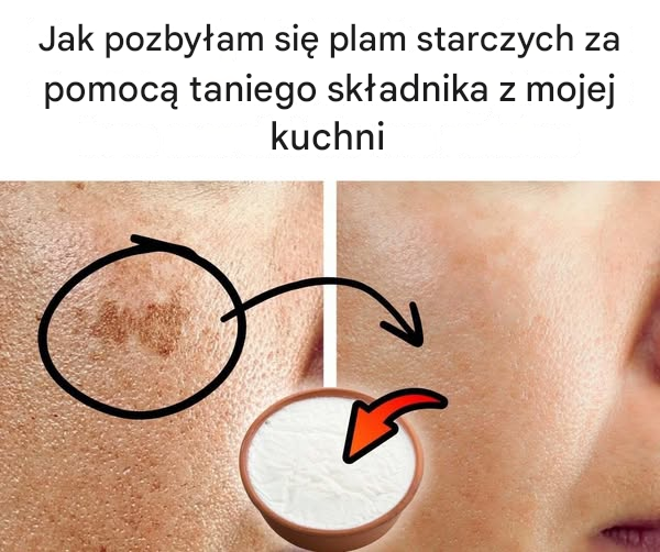Jak pozbyłam się plam starczych za pomocą taniego składnika z mojej kuchni
