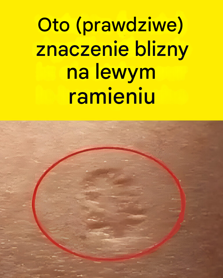 Blizny na ramieniu: co oznaczają?