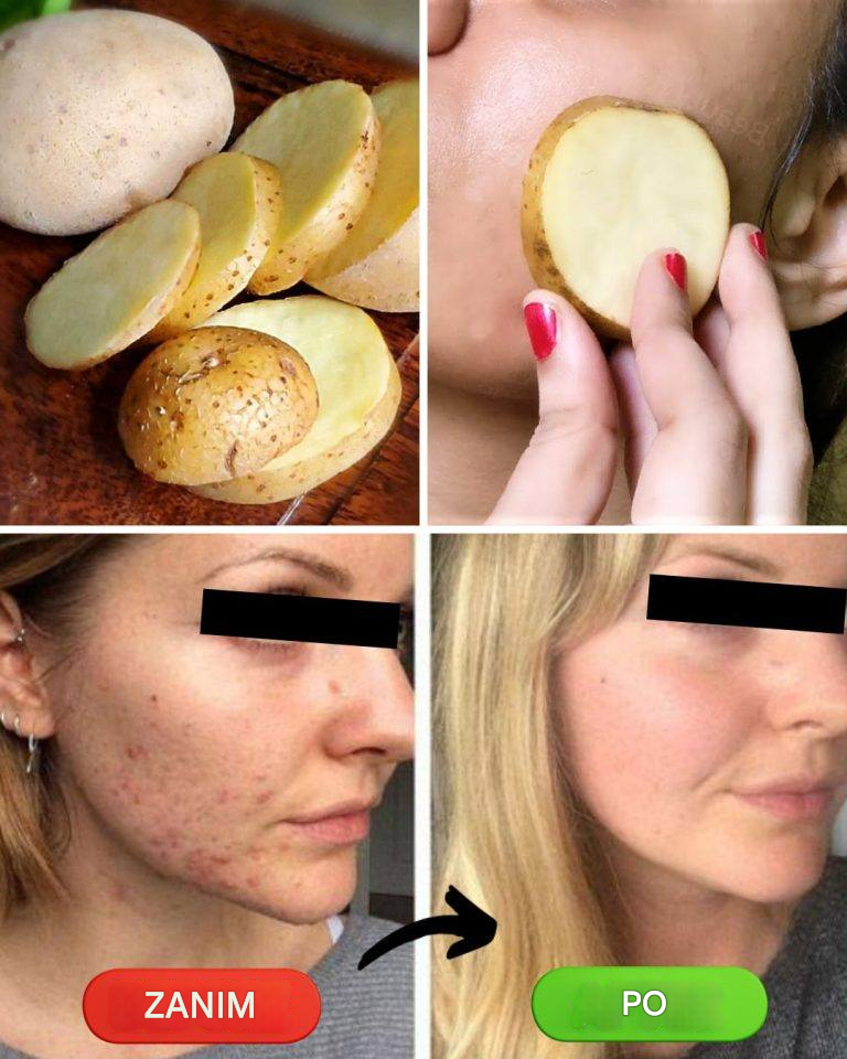 Pocieraj twarz plasterkiem ziemniaka każdego wieczoru – zaskoczy Cię, jak bardzo to pomaga!