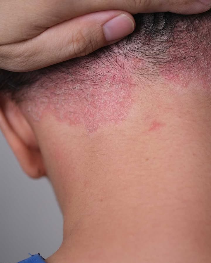 Odkryłam tę czerwoną plamę u mojego wnuka i wszyscy panikują. Co to jest i co powinniśmy zrobić?