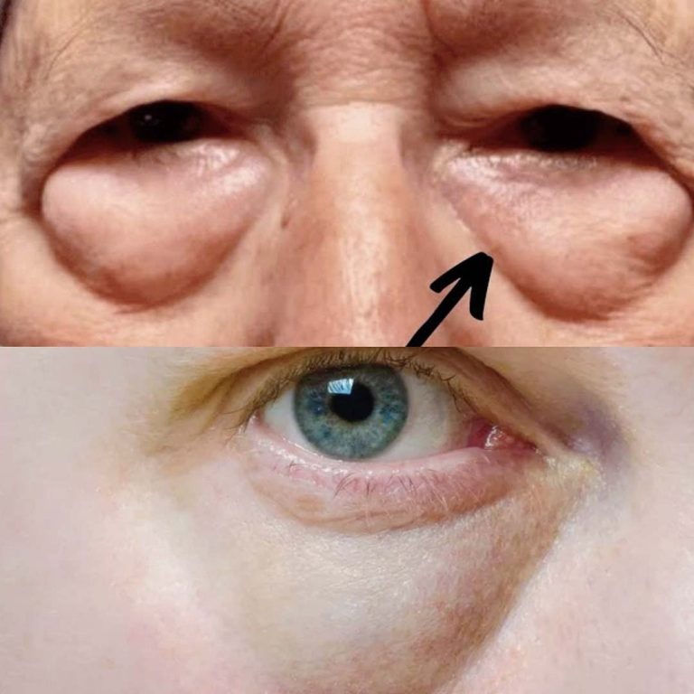 Tajemnice stojące za workami pod oczami i cieniami: nieoczekiwane odkrycia!