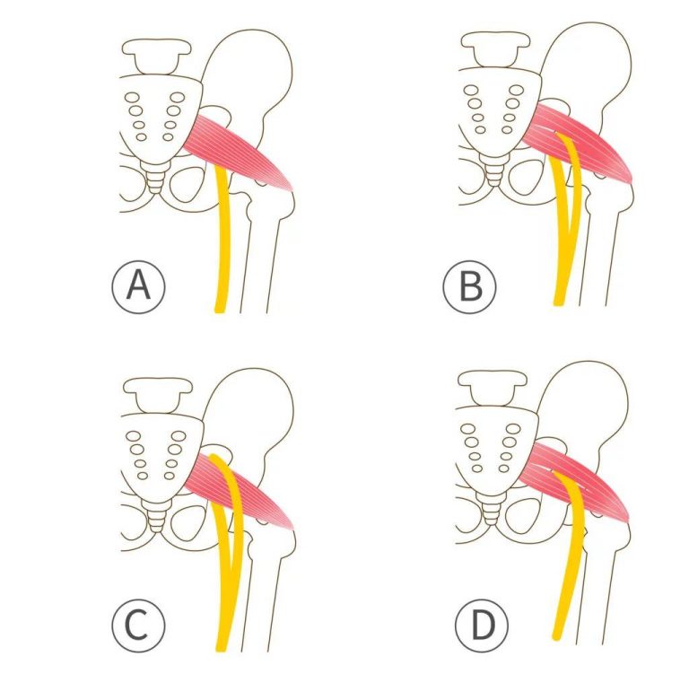 4 skuteczne ruchy łagodzące ból nerwu kulszowego i łagodzące ból dolnej części pleców poprzez rozluźnienie mięśnia gruszkowatego