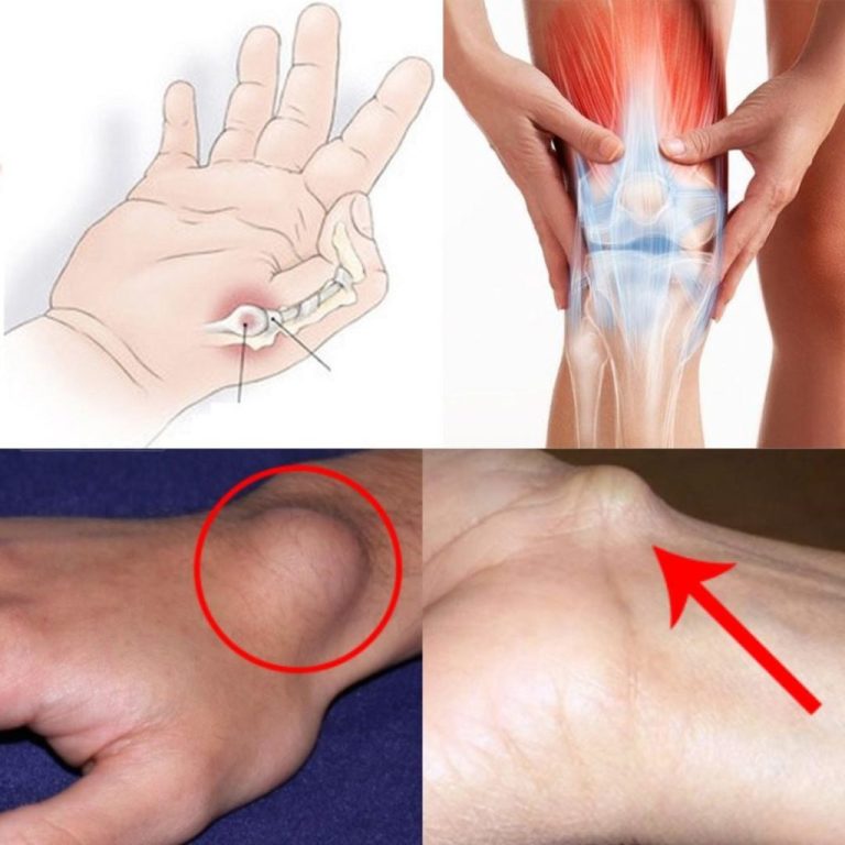 Cysta na stopie lub nadgarstku: co robić?