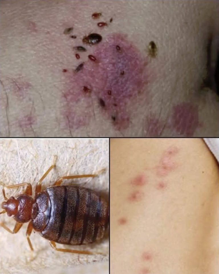 Lekarz wyjaśnia tę dolegliwość: wysypka, objawy, zdjęcia, metody leczenia i wiele więcej.