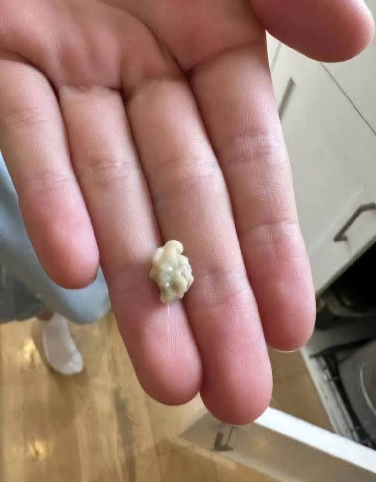 Oto, co musisz wiedzieć o kamieniach migdałkowych