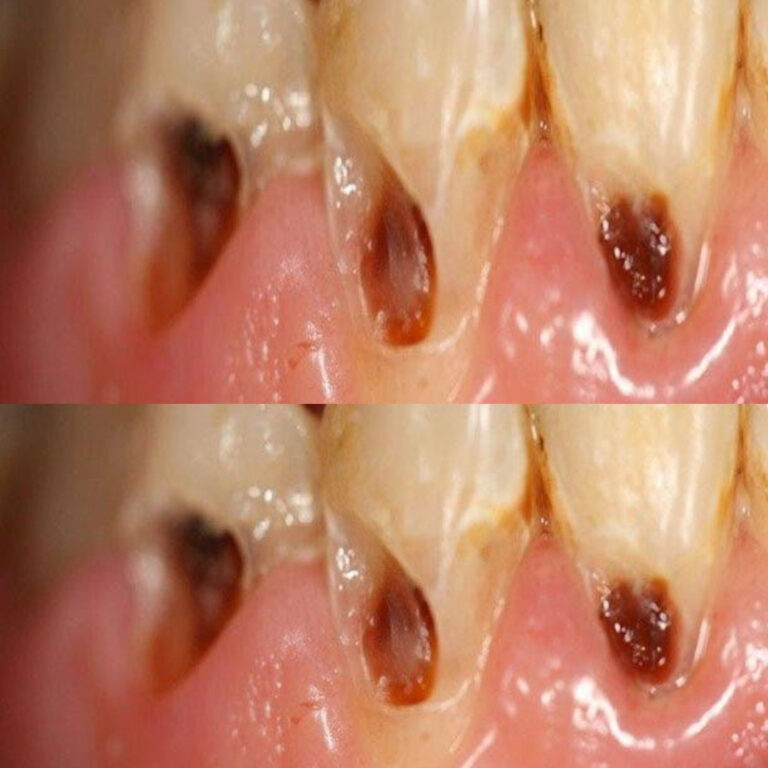 6 rzeczy, które należy zrobić, aby zapobiec próchnicy