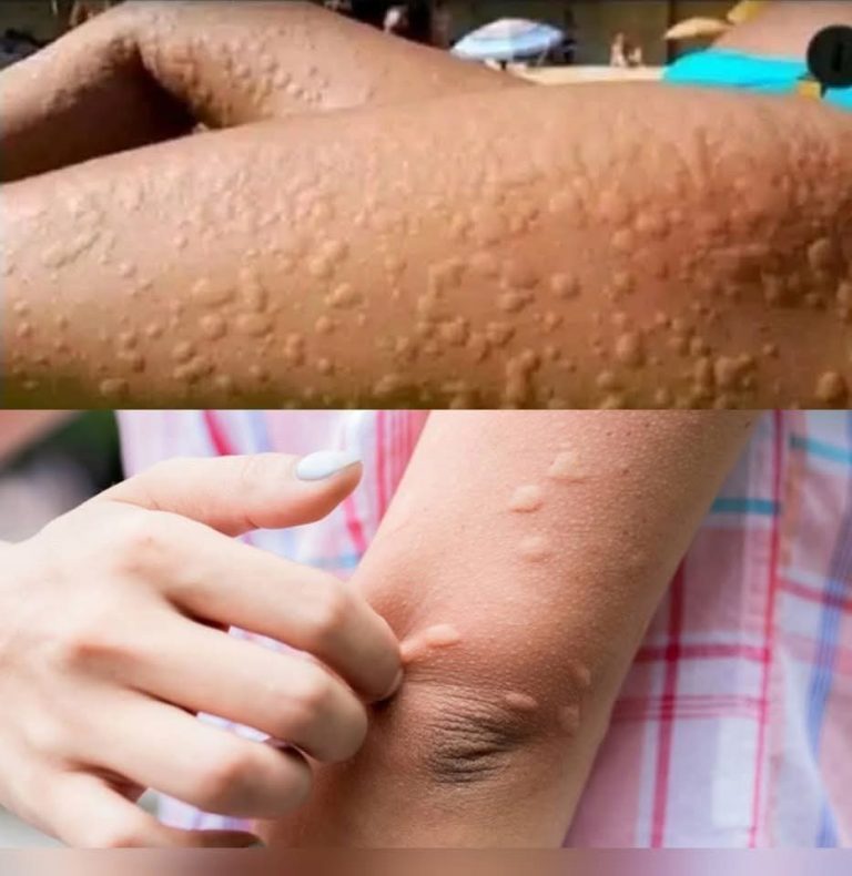 Dlaczego pokrzywka pojawia się na skórze? To zaskakujące czynniki, o których nie wiesz.