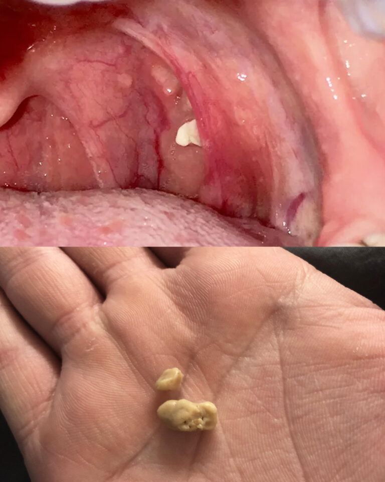 Dlaczego w gardle pojawiają się białe grudki?