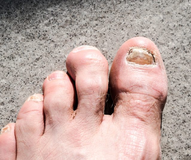 Odkryj ten bardzo prosty trik, aby pozbyć się grzybicy paznokci