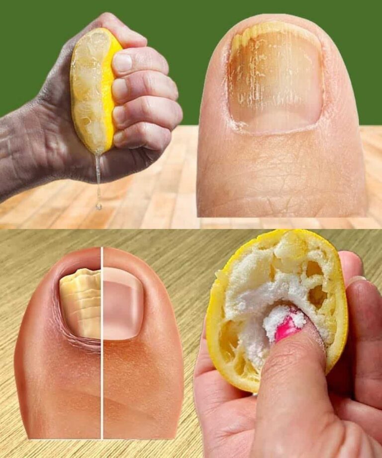 Wyeliminuj grzybicę paznokci dzięki tej naturalnej wskazówce i odzyskaj zdrowe stopy