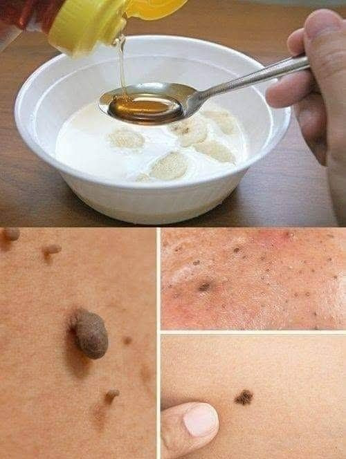 Naturalnie pozbądź się brodawek, zaskórników i plam starczych