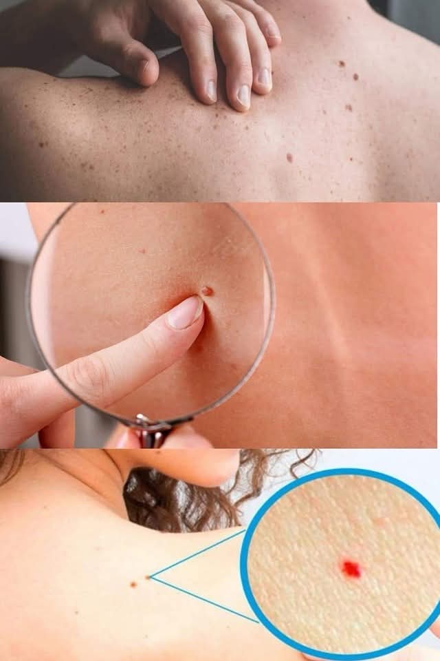 Dlaczego masz czerwone znamiona na skórze? Oto powód!!