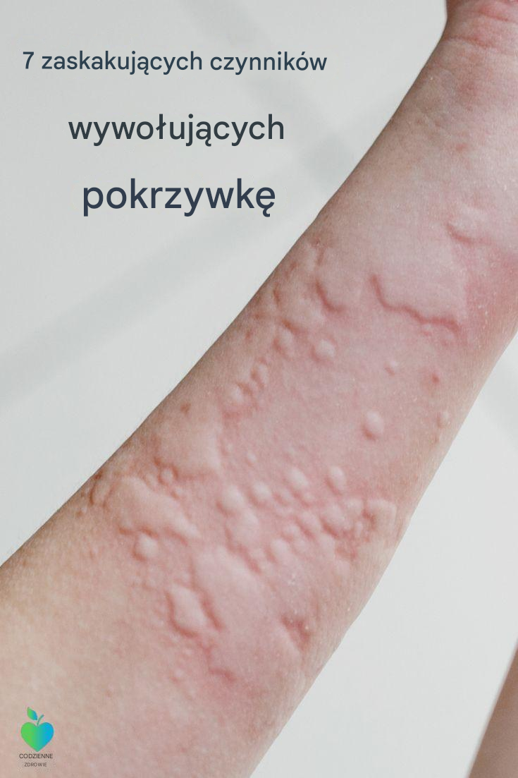 Czym jest pokrzywka? Objawy, przyczyny, diagnoza, leczenie i zapobieganie
