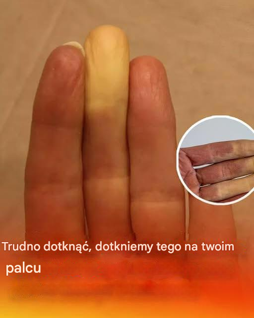 Co tak naprawdę oznacza, gdy jeden z palców robi się biały, gdy jest zimno?