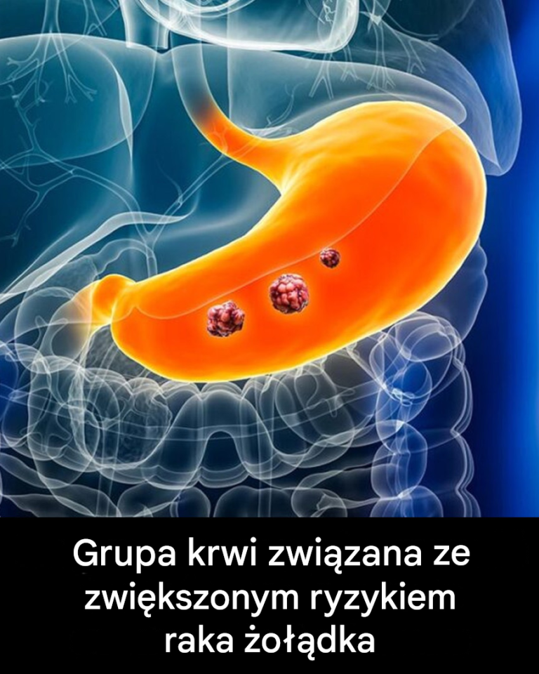Eksperci ujawniają grupę krwi, która wiąże się z największym ryzykiem zachorowania na raka żołądka