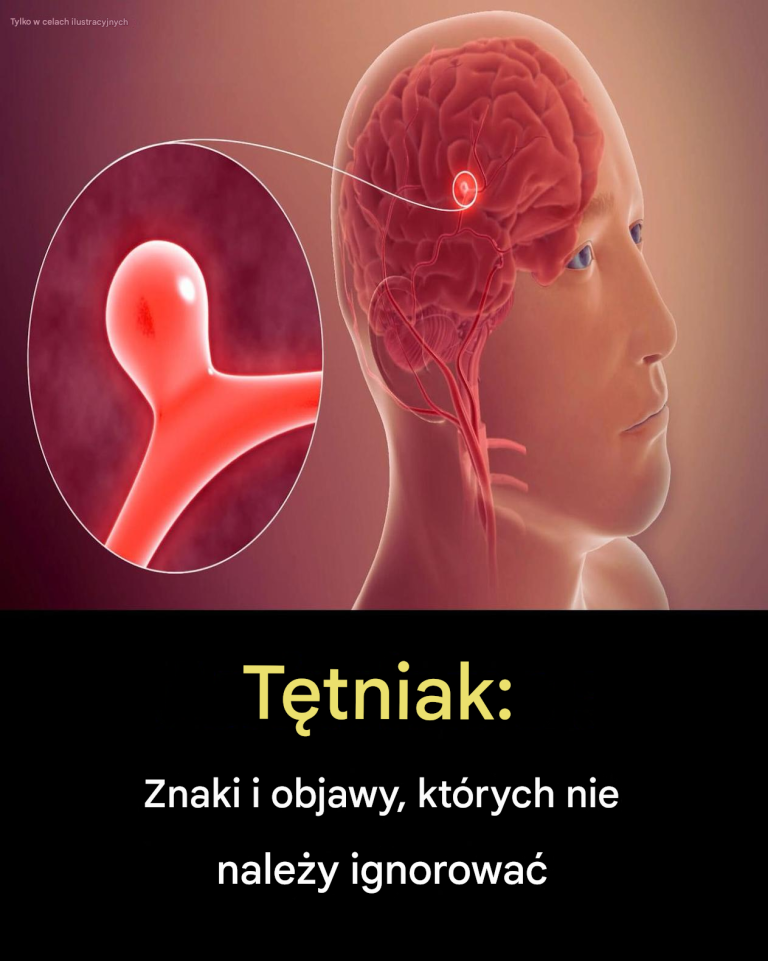 12 ostrzegawczych objawów tętniaka, których nie należy ignorować