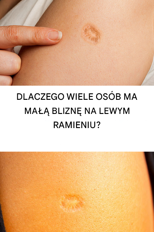 Dlaczego wiele osób ma małą bliznę na lewym ramieniu?