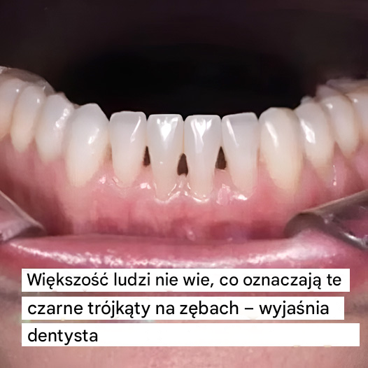 Dentysta wyjaśnia, co oznaczają czarne trójkąty między zębami