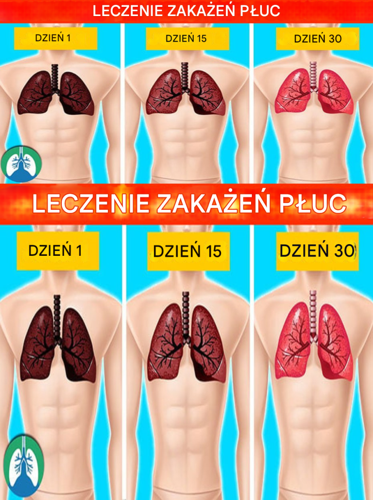 6 naturalnych sposobów leczenia infekcji płuc (domowe sposoby)