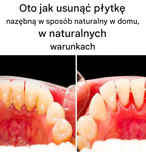 Oto jak usunąć płytkę nazębną w sposób naturalny w domu, w naturalnych warunkach