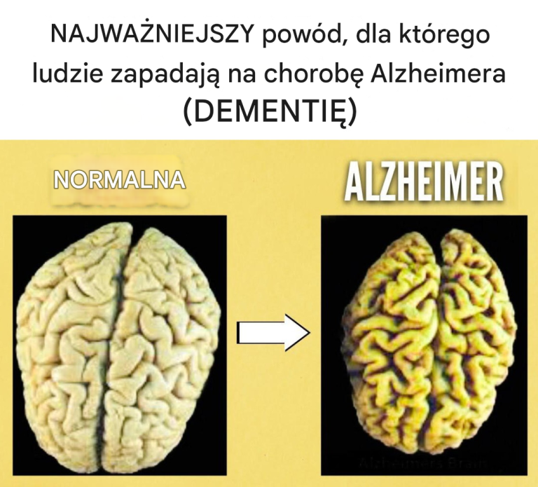 NAJWAŻNIEJSZY powód, dla którego ludzie zapadają na chorobę Alzheimera (DEMENTIĘ)