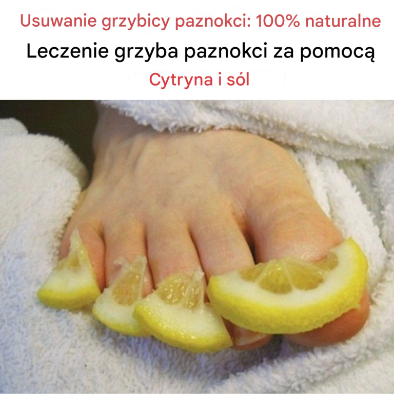 Wyeliminuj grzybicę paznokci: Skutecznie lecz grzybicę paznokci za pomocą 100% naturalnej cytryny i soli