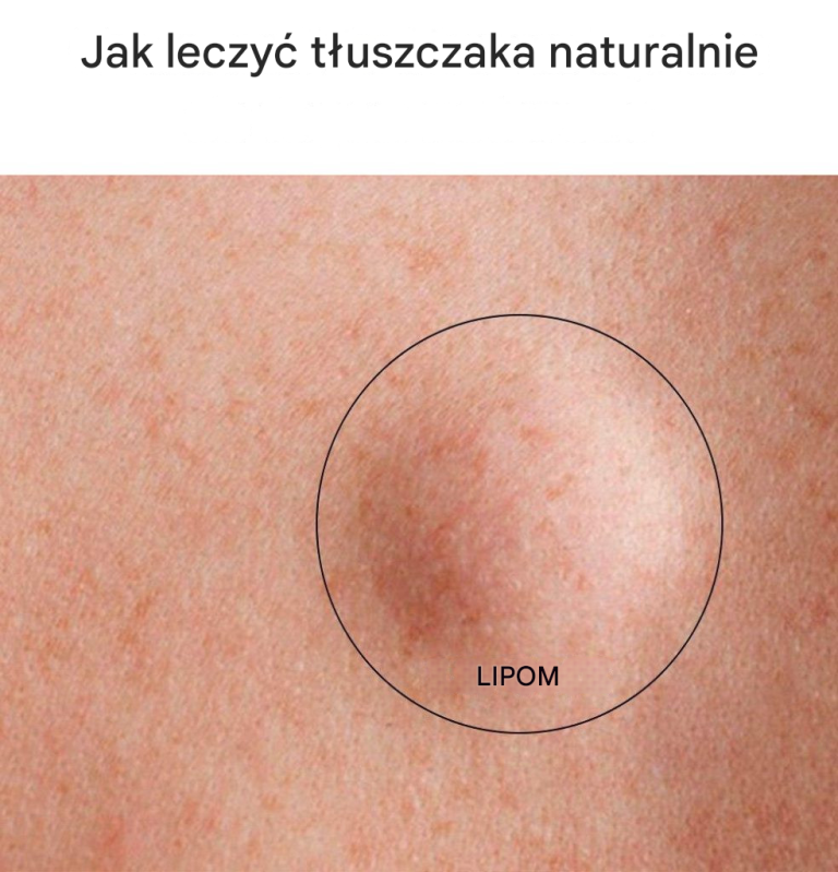 Jeśli zauważysz mały guzek pod skórą, może to być lipoma. Lipoma to masa tkanki tłuszczowej znajdująca się tuż między skórą a mięśniem. Chociaż lipoma jest na ogół nieszkodliwa, może być nieestetyczna lub krępująca. Zamiast uciekać się do operacji lub zastrzyków ze sterydami, wiele osób szuka naturalnych metod leczenia lipoma. W tym artykule omówiono kilka domowych sposobów leczenia lipoma w sposób naturalny. Zrozumienie lipoma Co to jest lipoma?  Lipoma to masa tkanki tłuszczowej znajdująca się tuż pod skórą, często gumowata i bezbolesna. Lipoma jest zwykle mała, mierząca od 1 do 3 cm i można ją wyczuć pod skórą. Rozwija się głównie na górnej części pleców, ramionach, rękach, pachach, pośladkach i górnej części ud. Rzadziej lipoma może rozwinąć się głębiej w mięśniach lub narządach. Przyczyny i czynniki ryzyka  Dokładna przyczyna lipoma pozostaje nieznana, ale kilka czynników może przyczyniać się do ich rozwoju: