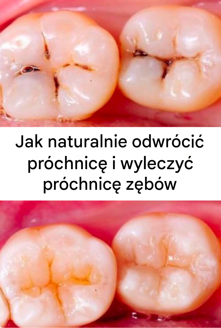 Jak naturalnie odwrócić próchnicę i wyleczyć próchnicę zębów