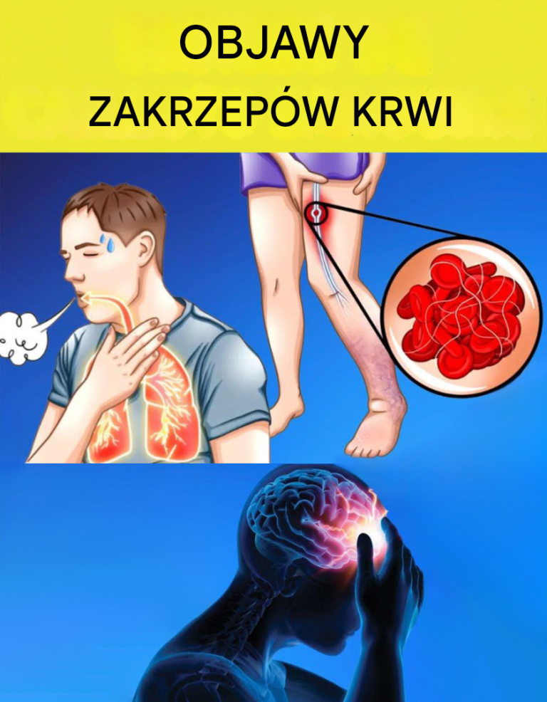 9 ostrzegawczych objawów zakrzepów krwi, których nie należy ignorować