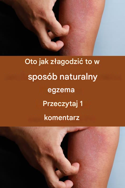 Jak złagodzić egzemę w sposób naturalny?