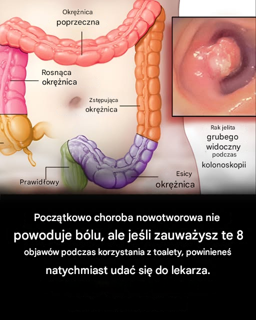 7 ostrzegawczych objawów raka jelita grubego, których nigdy nie należy ignorować