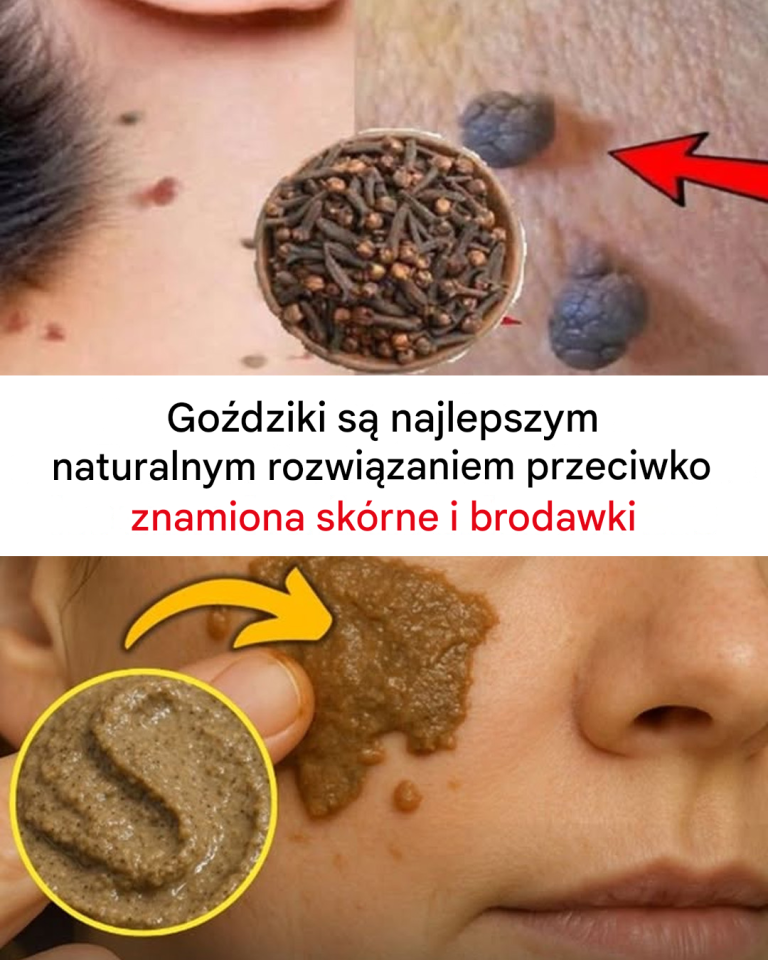 Goździki usuwają narośla skórne i brodawki: Jak je stosować?
