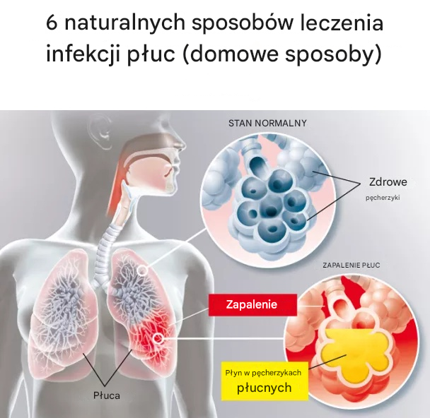 6 naturalnych sposobów leczenia infekcji płuc (domowe sposoby)