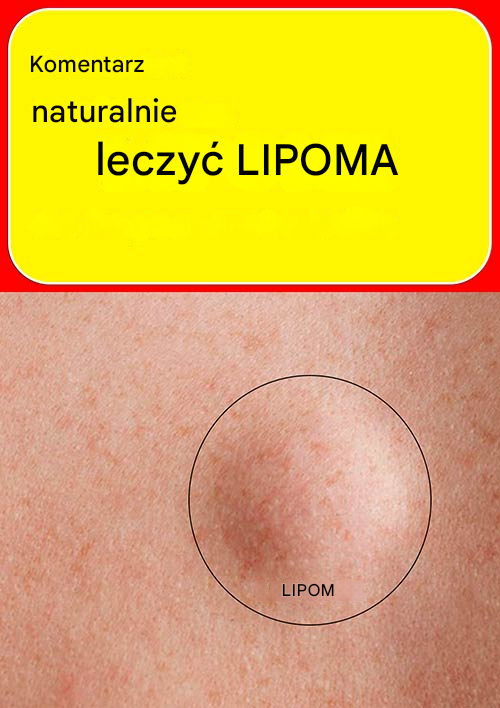 Jak leczyć tłuszczaka naturalnie