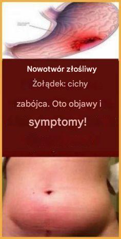 RAK ŻOŁĄDKA - CICHY ZABÓJCA. Oto jego objawy!