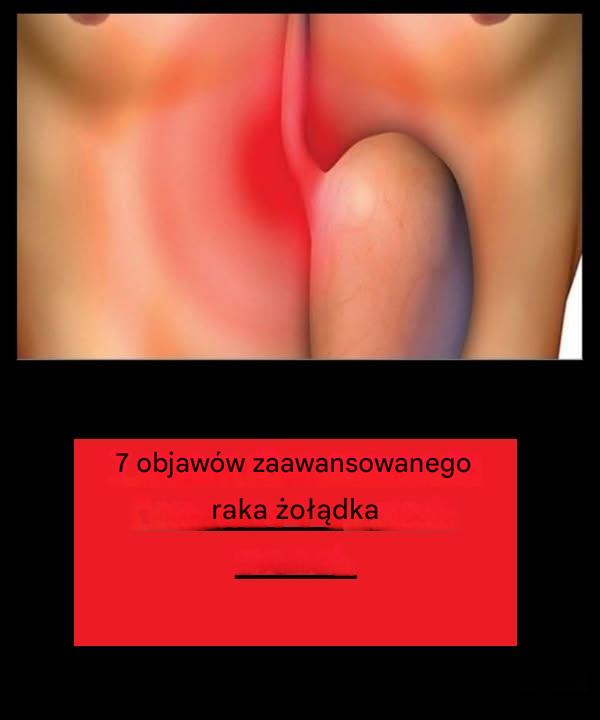 7 objawów zaawansowanego raka żołądka