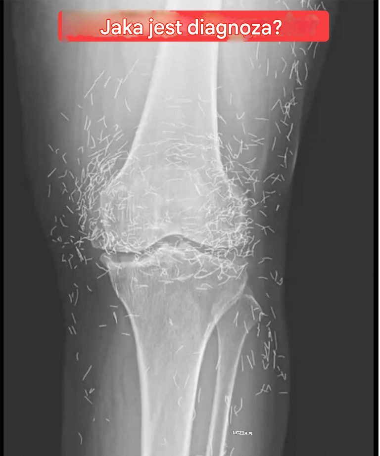 Światło rentgenowskie ujawnia setki złotych igieł w kolanach kobiety