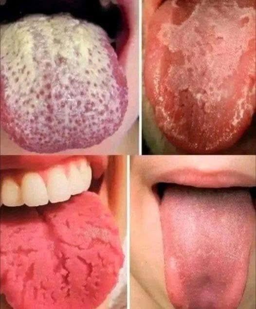 Jeśli masz te cztery objawy na języku, mogą one wskazywać na podstawowe schorzenia