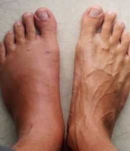 Miesiąc przed zawałem serca Twój organizm ostrzega: Oto 6 objawów!