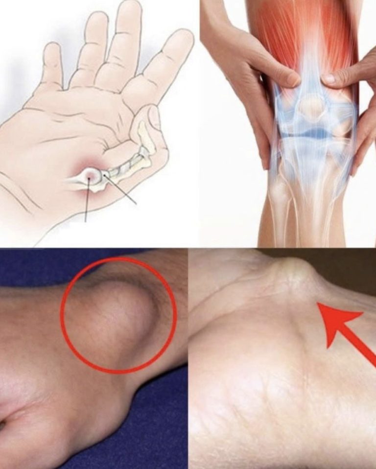 Cysta na stopie lub nadgarstku: co robić?