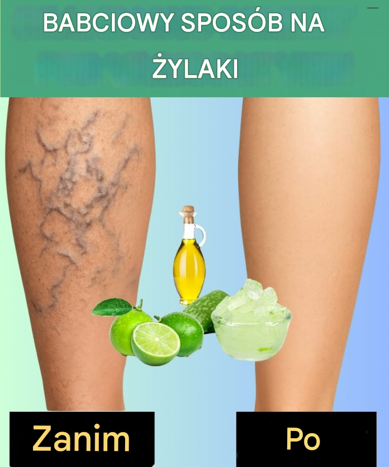 Grandma's Remedy for Varicose Veins: Naturalna receptura z Aloe Vera, ocet jabłkowy i cytryna